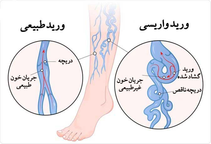 عوارض رگهای واریسی