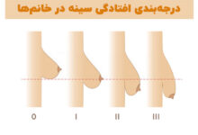 درمان خانگی افتادگی سینه