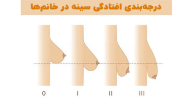 درمان خانگی افتادگی سینه