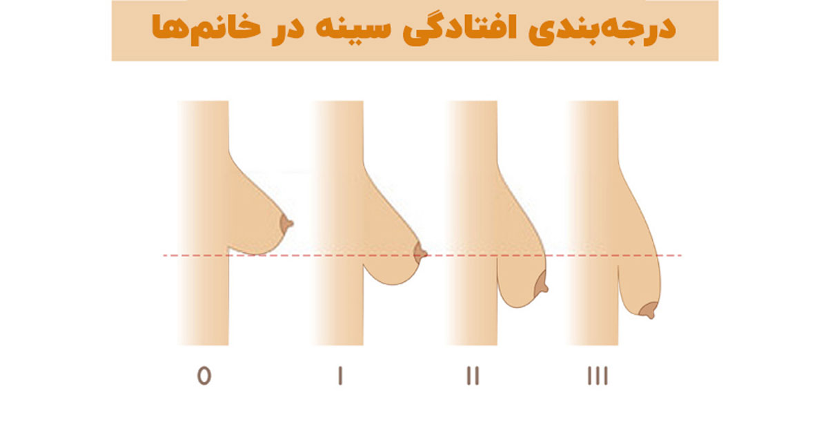 درمان خانگی افتادگی سینه