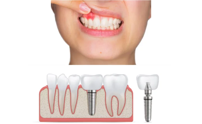 درمان عفونت لثه بعد از ایمپلنت چگونه است
